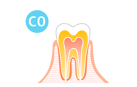 初期の虫歯(C0)