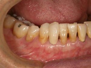 この写真の歯の根元のほうの黄色いところが、歯の根っこが露出してしまっている部分です。